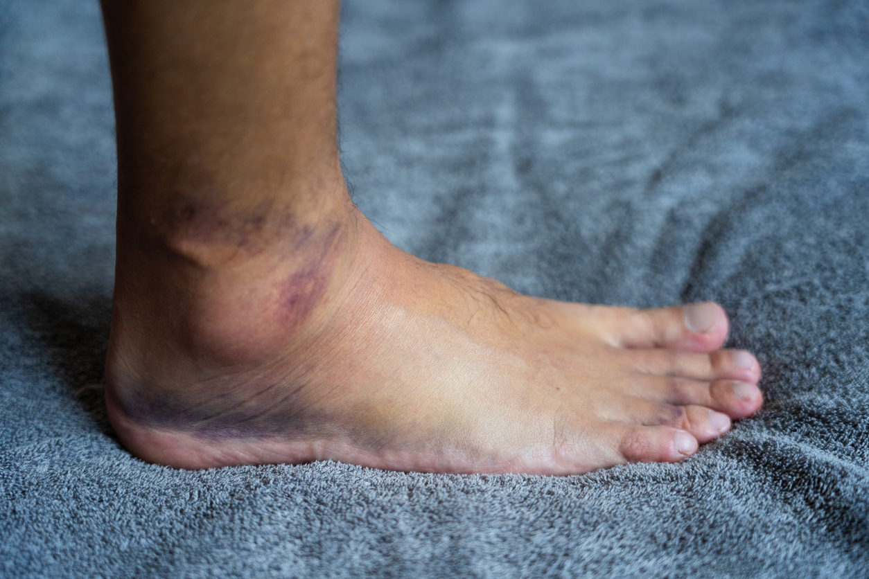 Close-up of a bruised and swollen ankle resting on a grey towel, highlighting the effects of a sprain